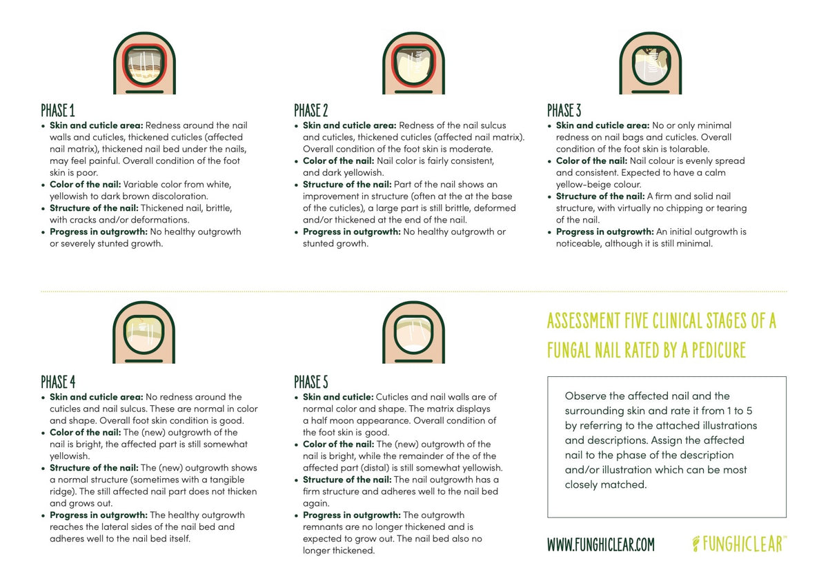 Infographic used by footcare professionals to inform five stages of Toenail Rating