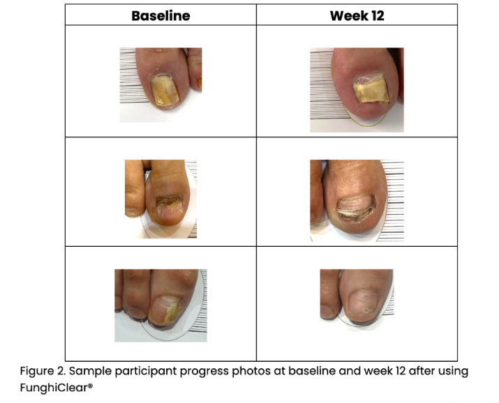 Figure 2. Sample participant progress photos at baseline and week 12 after using FunghiClear®